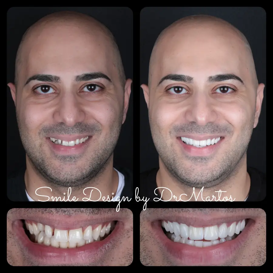 Smile Design before and after