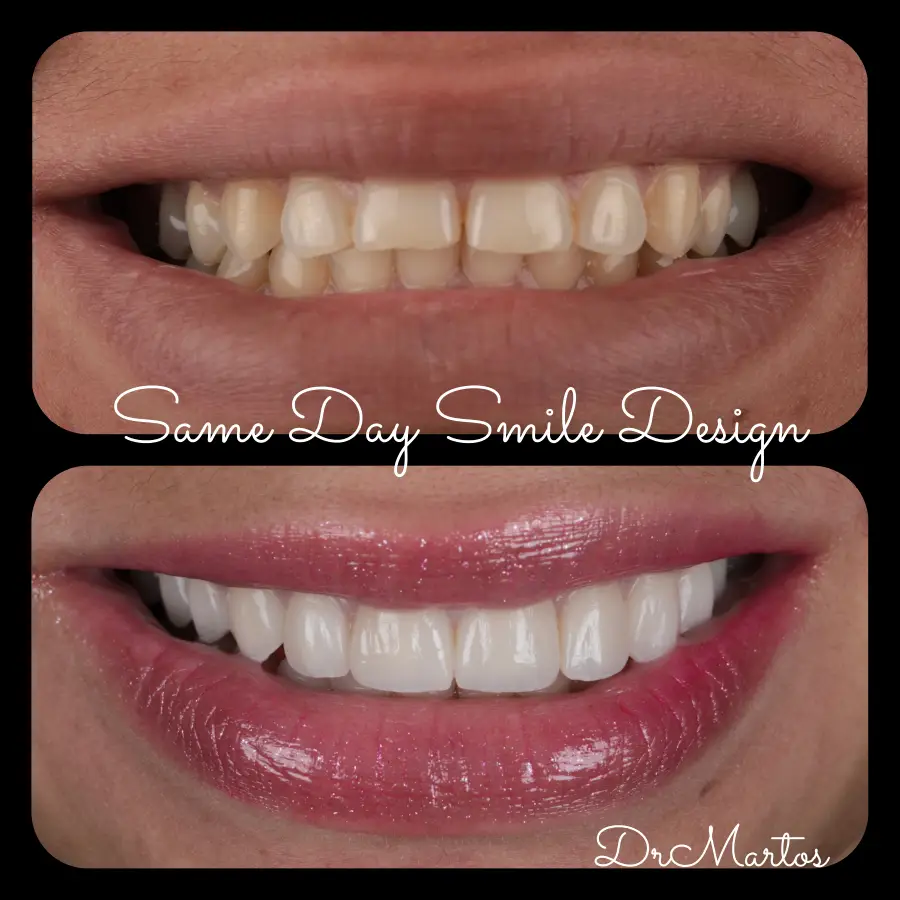Smile Design before and after