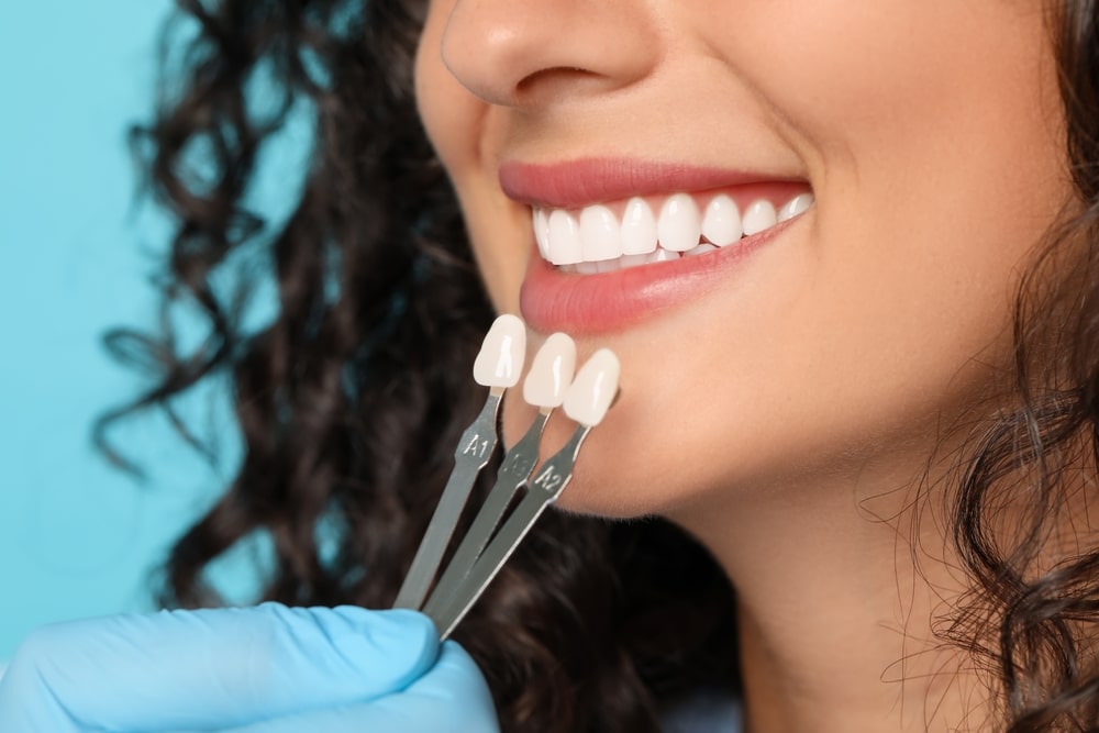 what veneers actually cost in miami